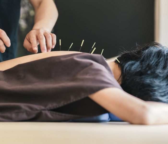acupunture-laguna-hills